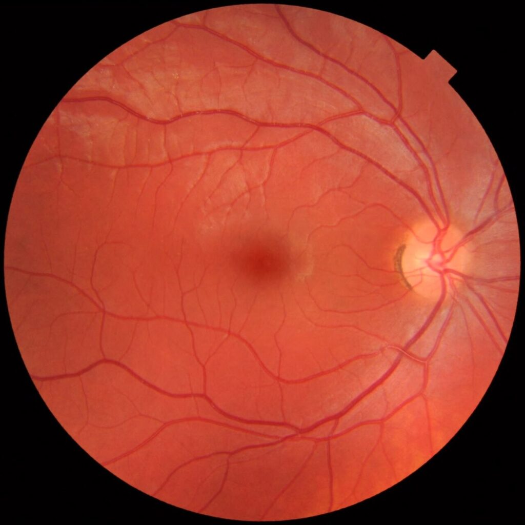 Fotografía de fondo de ojo con la mácula y la fóvea en el centro de la retina