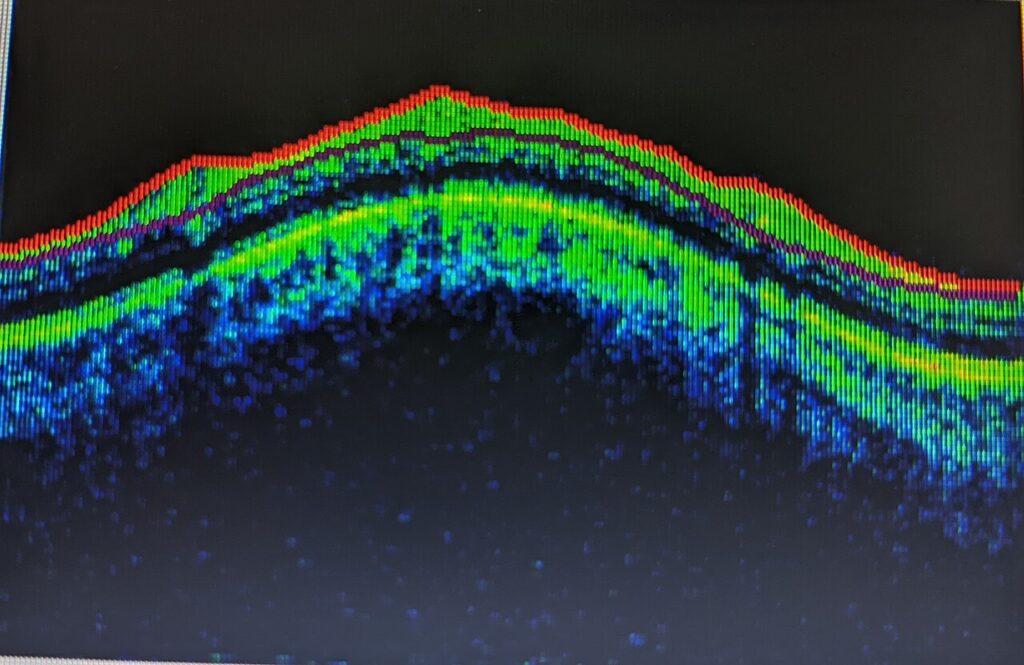 Corte transversal de la retina obtenido por tomografía de coherencia óptica